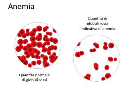 anemia e globuli rossi